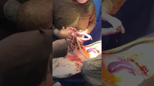 Редкие кадры , кесарево сечение
