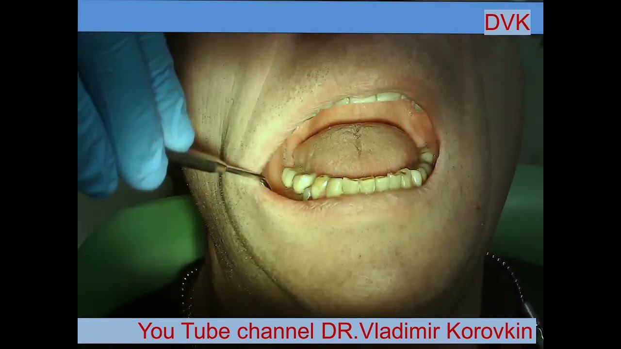 Infiltration anesthesia for treatment 45 tooth.#localanaesthesia #nerveblock #infiltrationanesthesia