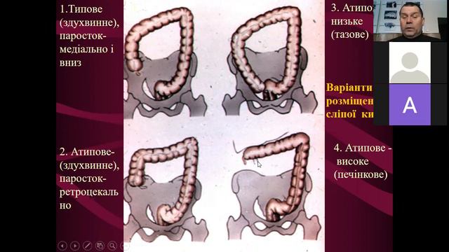 Апендицит окремо — копия смотреть онлайн