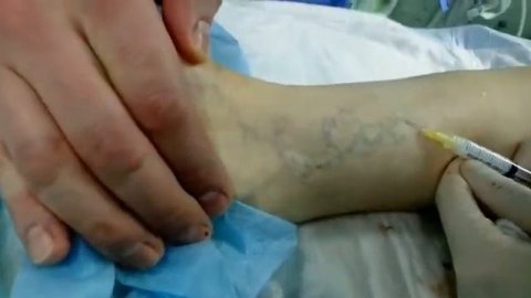 Склеротерапия вен нижних конечностей