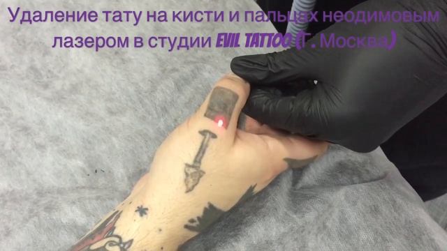 Удаление татуировки на кисти  неодимовым лазером #удалениетату #удалениетатуаж #лазерноеудалениетат