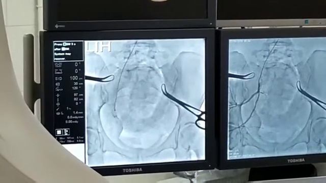 Эмболизация маточных артерий во время кесарева сечения