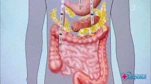 Синдром раздраженного кишечника. Здоровье. Фрагмент выпуска от 22.10.2017