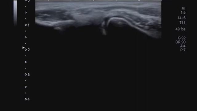 Лучевой фронтальный скан - лучевая коллатеральная связка смотреть онлайн