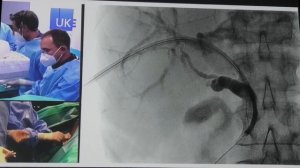 31 Live Enoclub Nord P Dautel & G Schachschal Дренирование желчных протоков на отключенной ДПК посл