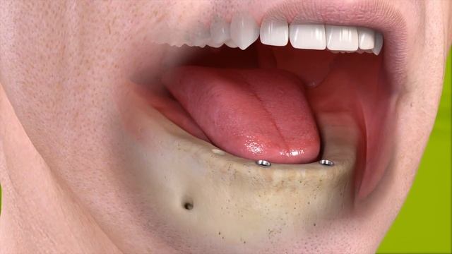 Straumann - Fixed restoration with 4-6 implants, all straight смотреть онлайн