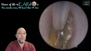 SHOCKING MISDIAGNOSIS! 251 #ear #earwax #earwaxremoval #earcleaning #fyp #asmr #asmrearwax #foryou