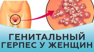 Генитальный герпес у женщин.