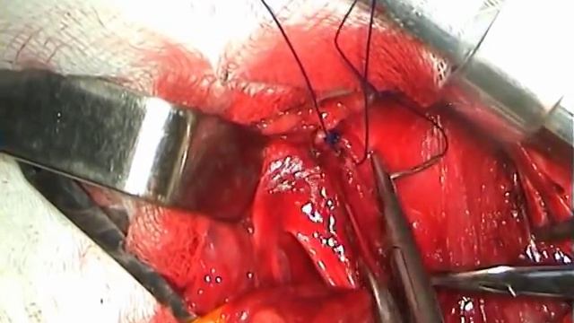 Герниотомия,герниопластика по Шоулдайсу