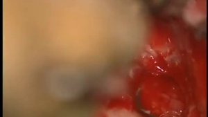 Left Tympanoplasty Mastoidectomy by William Slattery, MD