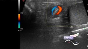 УЗИ мошонки - Перекрут семенного канатика