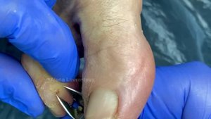 Большая мозоль между пальцев / Целующиеся мозоли / мозоль от обуви