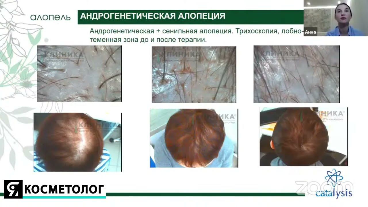 Миноксидил: за, против или вместо? Вебинар цикла «ВТОРОЕ МНЕНИЕ» смотреть онлайн