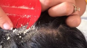 useful Tips ! flakes lice comb removal with comb and scalp combing scratching on head