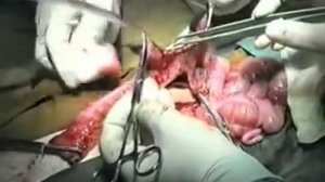 резекция кишечника, анастомоз, стома-Operation on intestines