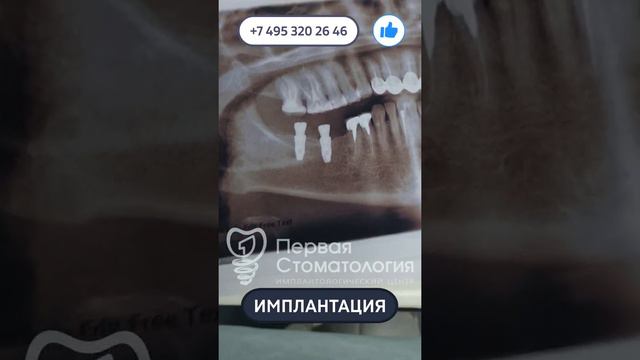 Имплантация зубов пациенту. Интересный случай.