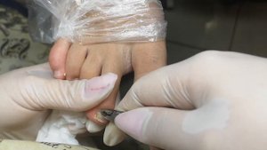Классическая обработка пальцев в педикюре/Трещина на ногте/Восстановление сломанного ногтя на ногах