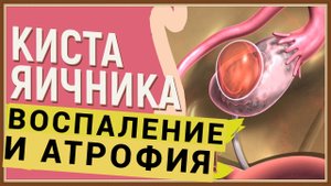 КИСТА ВОСПАЛЕНИЕ АТРОФИЯ ЯИЧНИКА