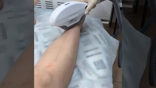 Элос эпиляция