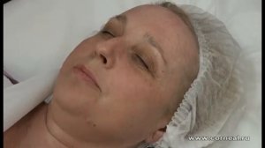 1мл достаточно для биоревитализации лица