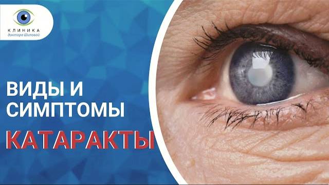 Типы катаракты / Клиника доктора Шиловой смотреть онлайн