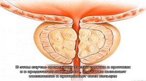 Кальцификаты в неоднородной эхоструктуре предстательной железы: что это?