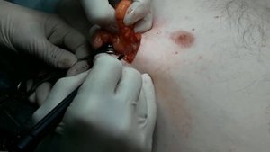 Удаление межмышечной липомы с применением радиоволнового скальпеля