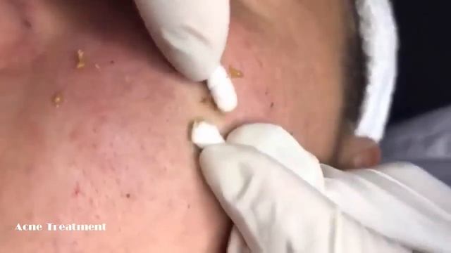 УГРИ   ПРЫЩИ НА ЛИЦЕ! ДАВЛЮ Как избавиться от черноголовых ! How to get rid of blackheads3