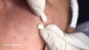 УГРИ ПРЫЩИ НА ЛИЦЕ! ДАВЛЮ Как избавиться от черноголовых ! How to get rid of blackheads3