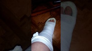 Закрытый перелом лодыжки со смещением моя история 3 часть