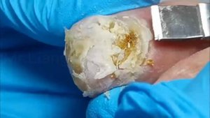Hoof trim! Yellow,long and thick fungus nails treatment Part 2. Super thick nails cutting.