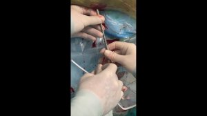 Мини-перкутранная нефролитотрипсия в положении на спине