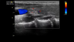 УЗИ правой подключичной и позвоночной артерии