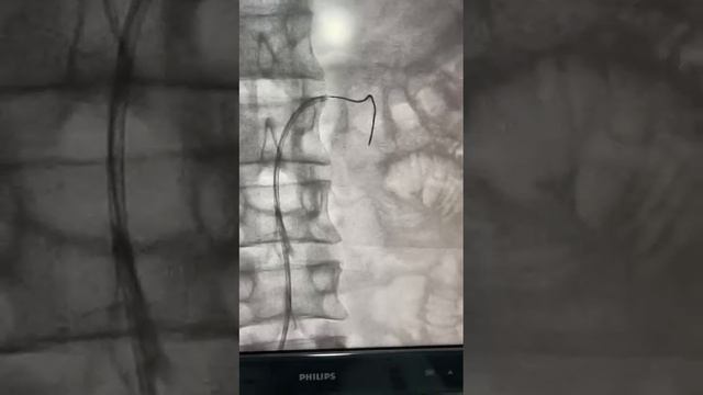 Pseudo aneurysm of subsegmental renal artery selectively embolised with single microcoil.