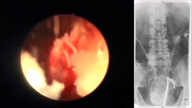 Allium Stents- Therapieoptionen bei Ureterdefekten, Dr. Neymeyer смотреть онлайн