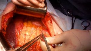 Ушивание культи кишки