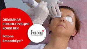 Омоложение век и параорбитальной области Fotona  SmoothEye™