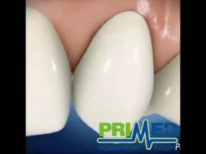 УСТАНОВКА ПЛОМБЫ В ЗОНЕ УЛЫБКИ. СТОМАТОЛОГИЯ PRIMED