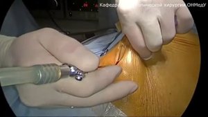 Введение троакаров