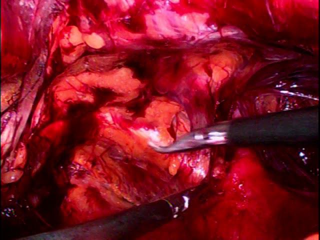 laparoscopic eTEP right inguinal hernia смотреть онлайн