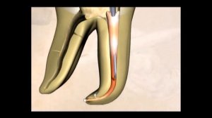 Как пломбировать горячей гуттаперчей (3 часть)