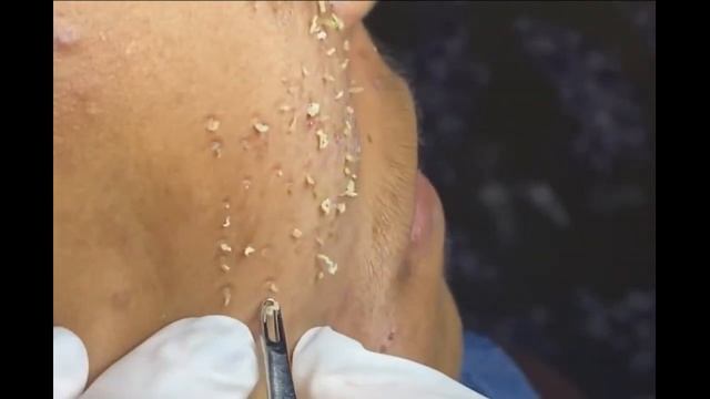 Удаление черных точек 2021 - pimple popping -  blackheads removal - make your day relaxing 001