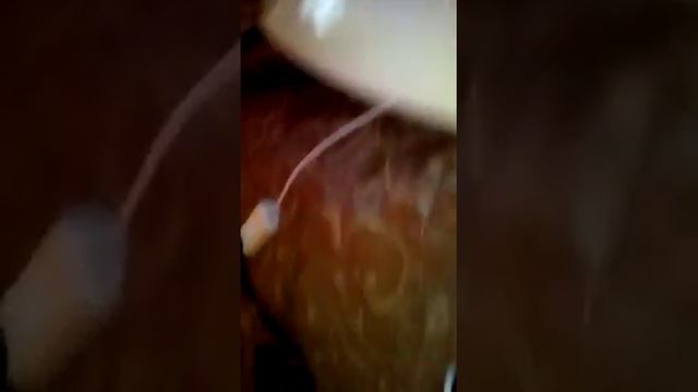 Хиджама ,кровопускание Часть1.
