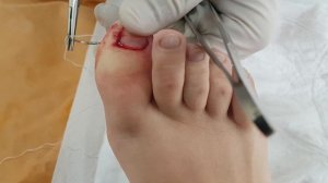Вросший ноготь