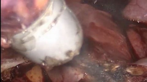 Миома матки больших размеров. Лапароскопическая миомэктомия.