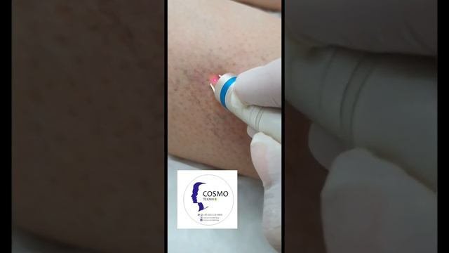 Удаление капиллярной сетки Диодным лазером в косметологическом салоне Cosmo Teknik, Алания смотреть онлайн
