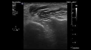 Слюннокаменная болезнь поднижнечелюстной железы.