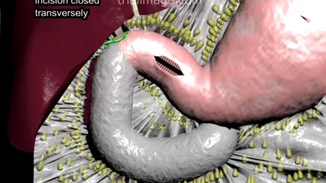 Heineke-Mikulicz Pyloroplasty (in 1 minute) Animation by Cal Shipley, M.D. смотреть онлайн
