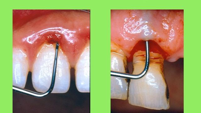 Оценка состояния тканей пародонта Часть 1 смотреть онлайн