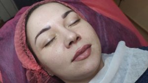 Протокол Пилинг Dermagenetic TCA 20%